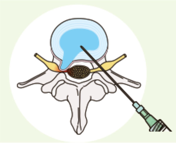 ヘルニコア注入療法