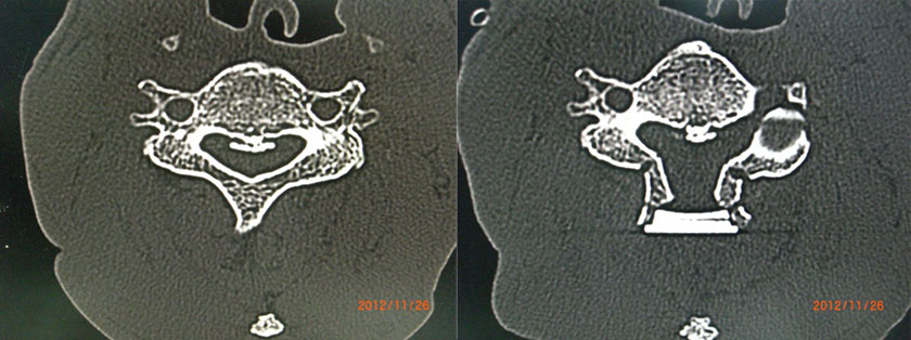 頚椎後縦靭帯骨化症に対する椎弓形成術施行症例