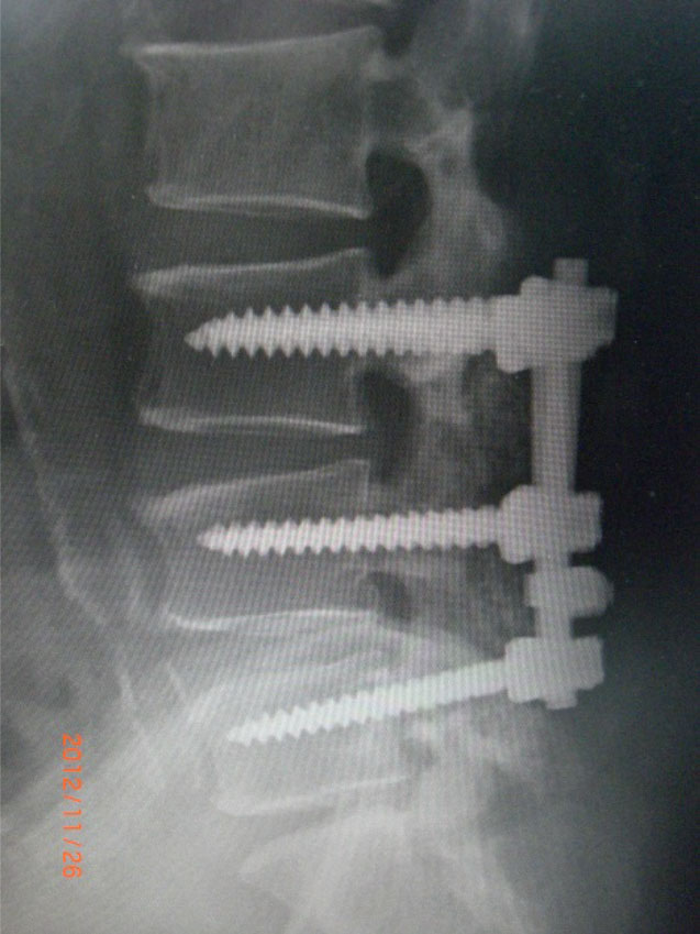 専用のスクリューを用いた腰椎除圧固定術症例