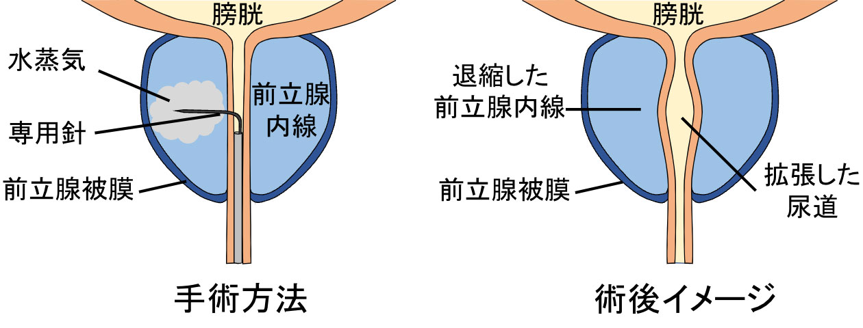 前立腺肥大の新しい治療法を導入しました