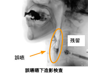 誤嚥嚥下造影検査