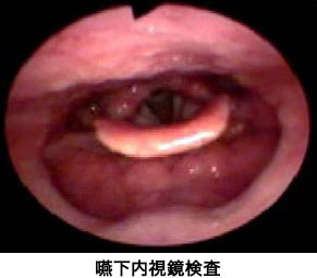 嚥下内視鏡検査 