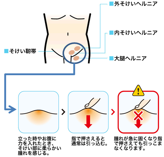 そけいヘルニア