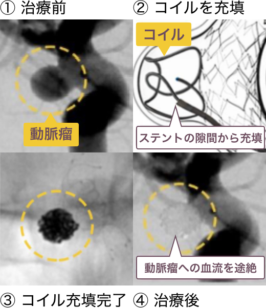 未破裂動脈瘤に対する治療