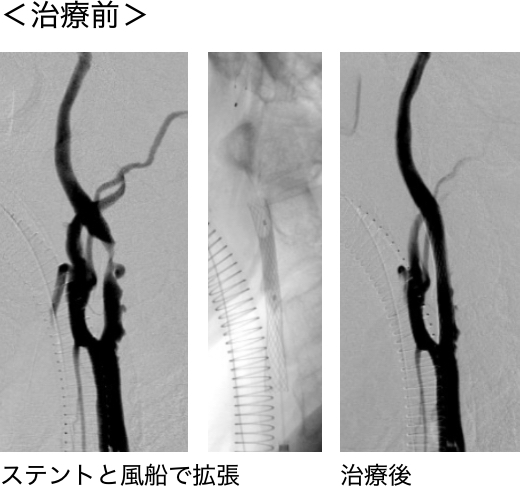 内頚動脈狭窄症に対するステント留置術