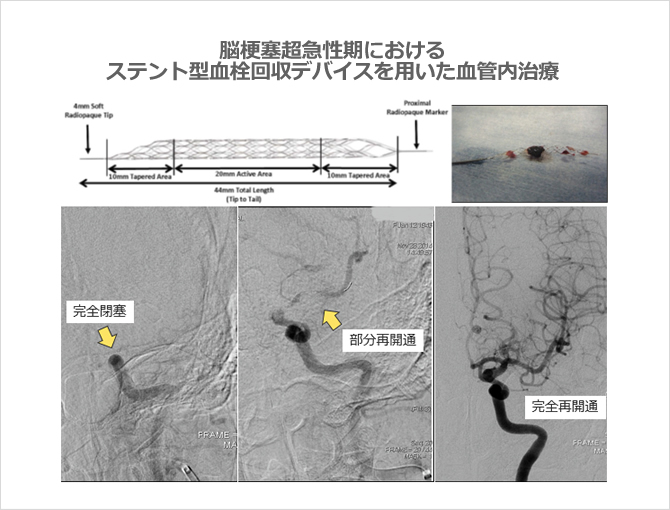 脳梗塞急性期におけるステント型血栓回収デバイスを用いた血管内治療