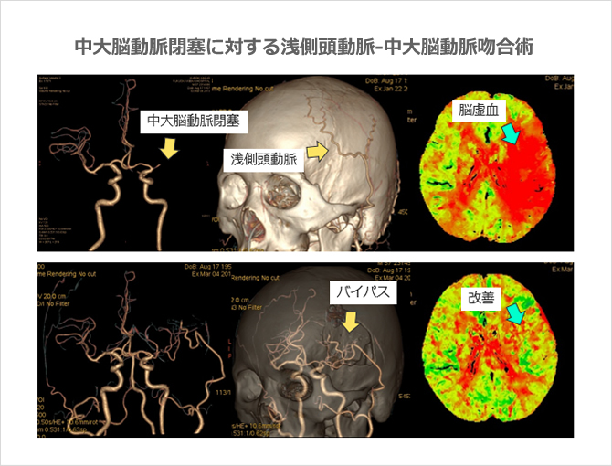中大脳動脈閉塞に対する浅側頭動脈-中大脳動脈吻合術