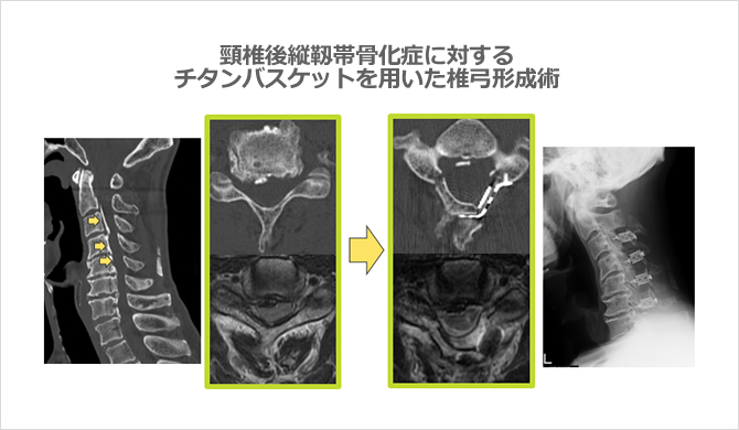 頸椎後縦靭帯骨化症に対するチタンバスケットを用いた椎弓形成術