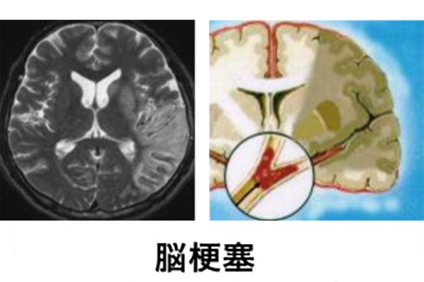 脳梗塞