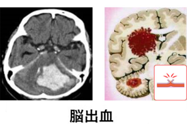 脳出血