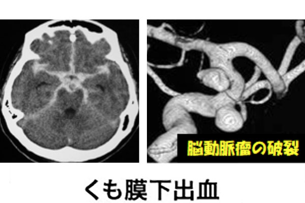 くも膜下出血