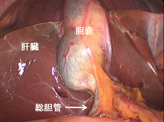 胆嚢を胆嚢把持鉗子で持ち上げます。