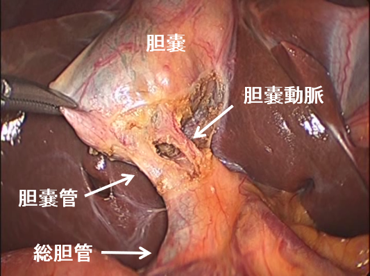 胆嚢管・胆嚢動脈を慎重に剥離します。