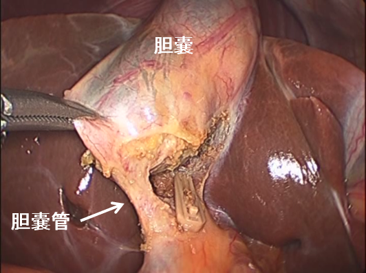 胆嚢動脈を吸収性クリップでクリッピングして切離します。