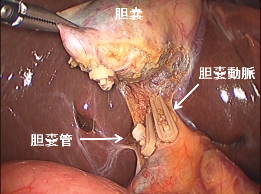 胆嚢管を吸収性クリップでクリッピングして、胆嚢管を切離します。