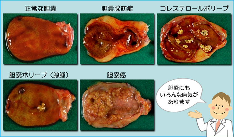 胆嚢の病気