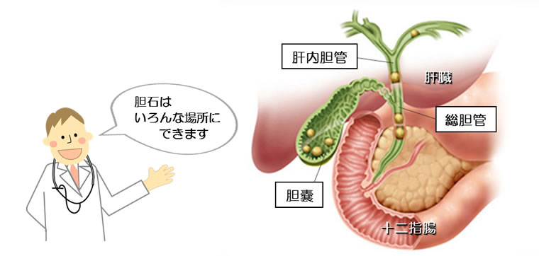 胆石はいろんな場所にできます