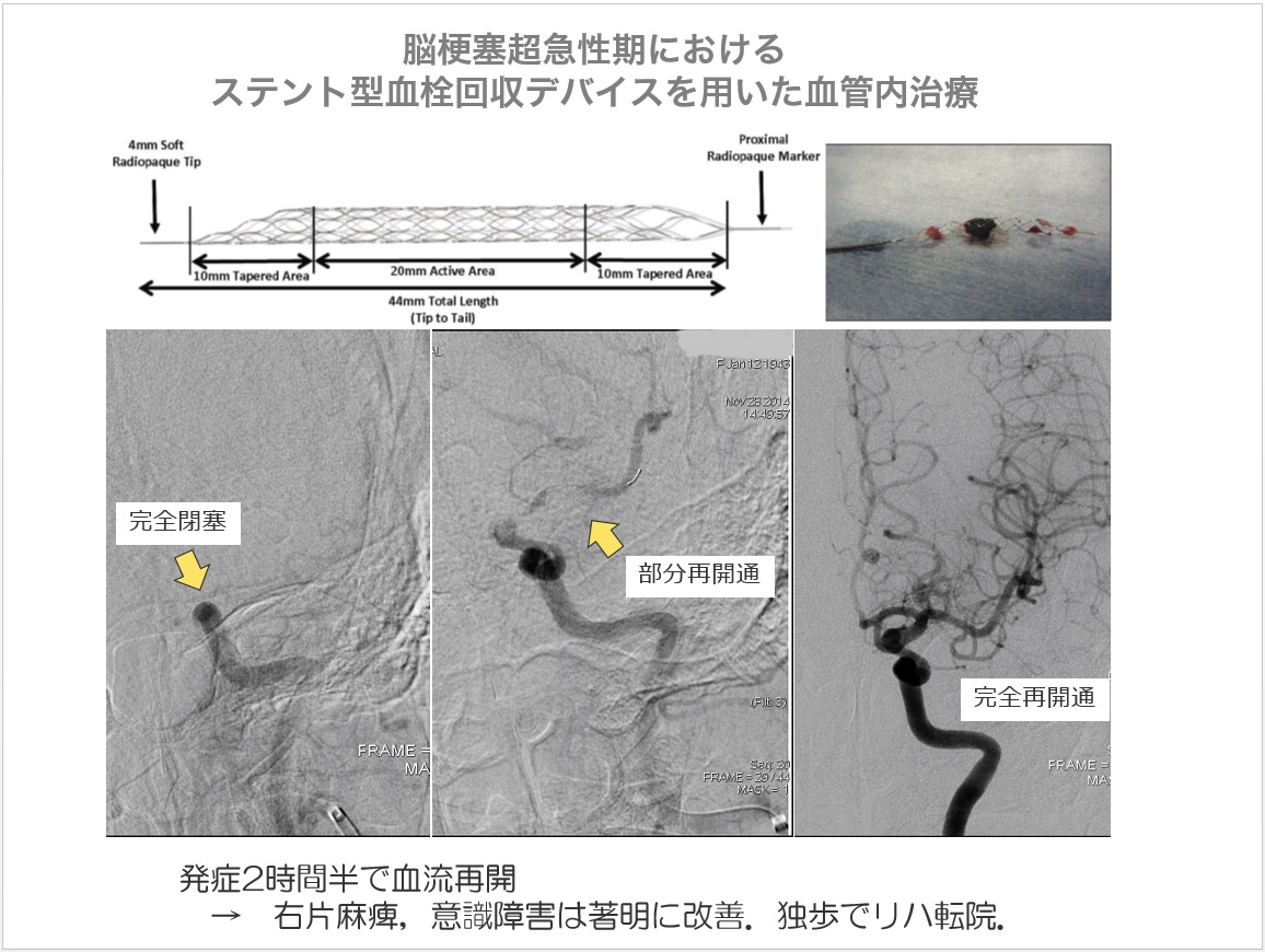 脳梗塞急性期におけるステント型血栓回収デバイスを用いた血管内治療